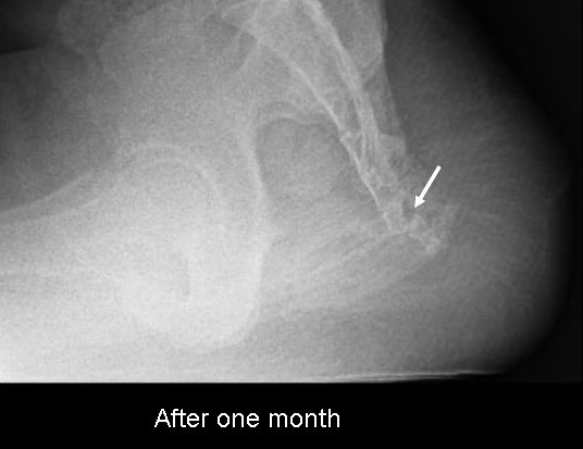 dislocation after one month.jpg